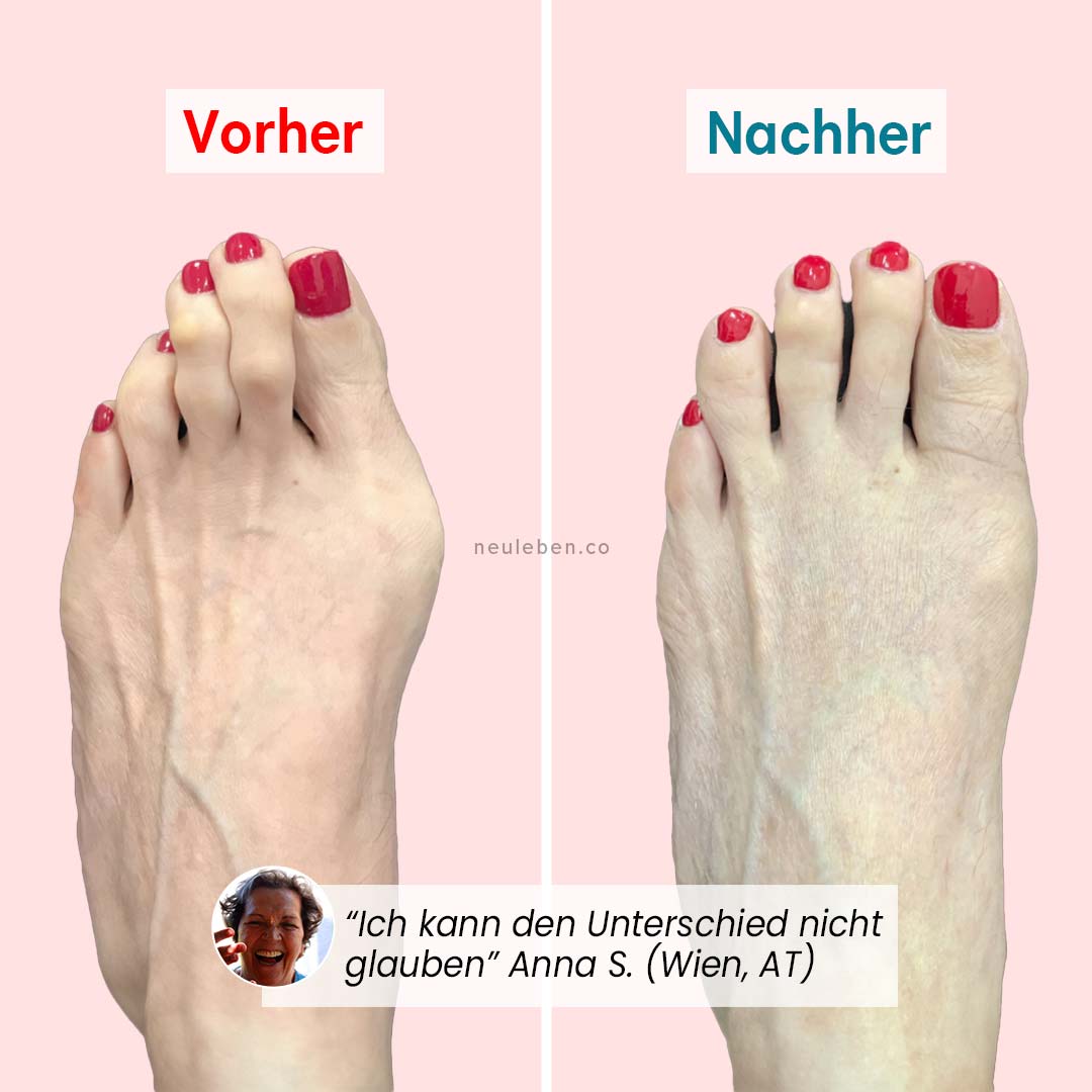 PerfectToes - Natürlicher Zehenkorrektor