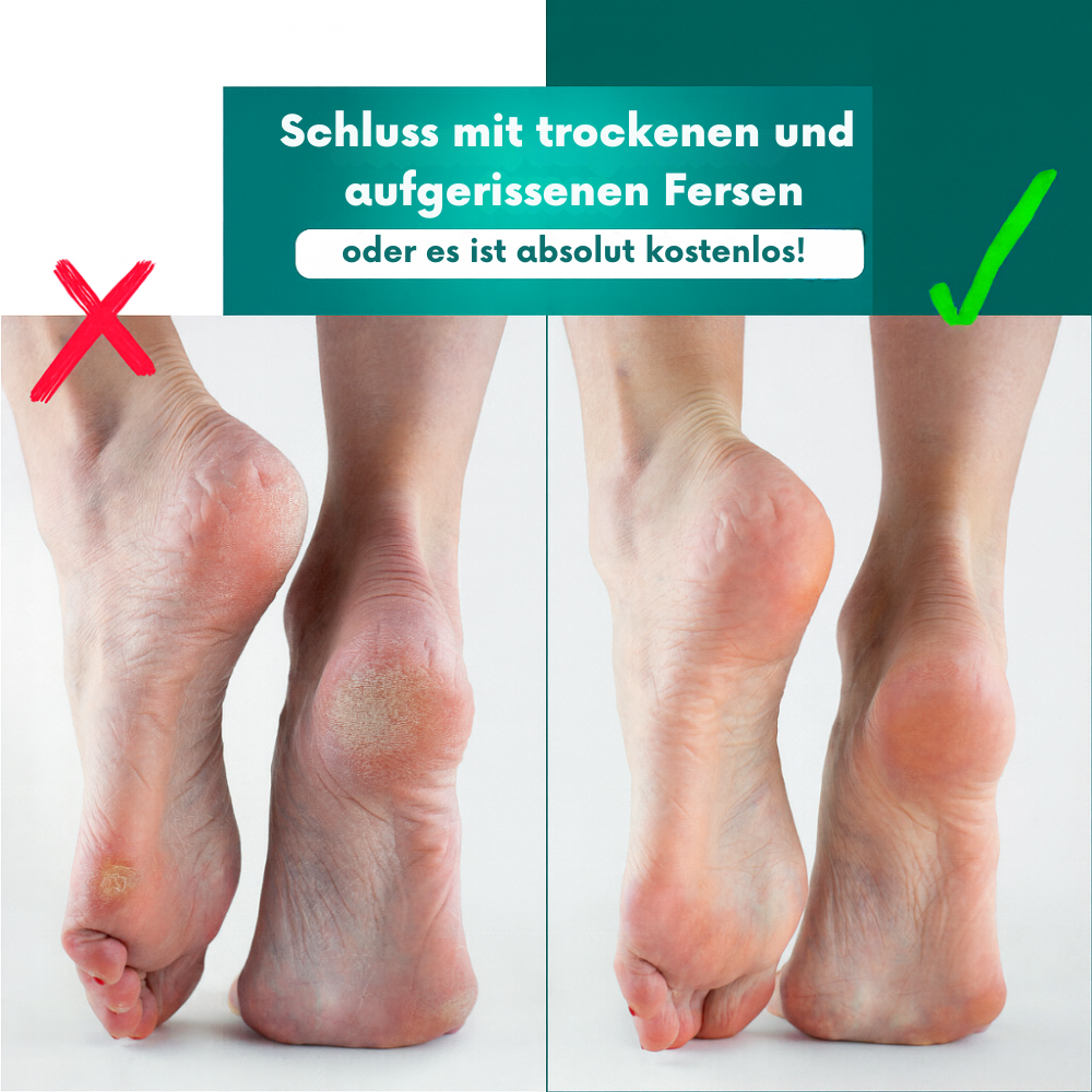SilkySole™ Profi Hornhautentferner – Ideal für Zuhause